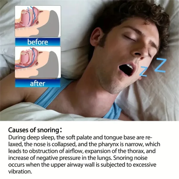 20-100pcs Snoring Stickers Breathing Nose Strips Physical Airway Expansion for Improved Nose Vent Anti-Snoring Comfort Sleep Aid - Image 4