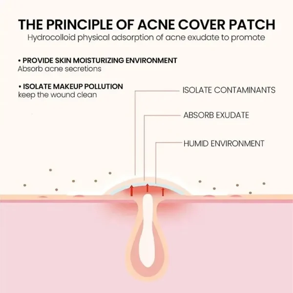 200pcs Repair Acne Patch Facial Skin Care Fade Blemishes Pimple Marks Closed Acne Blemishes Cover Acne Pimple Repair Patch - Image 5