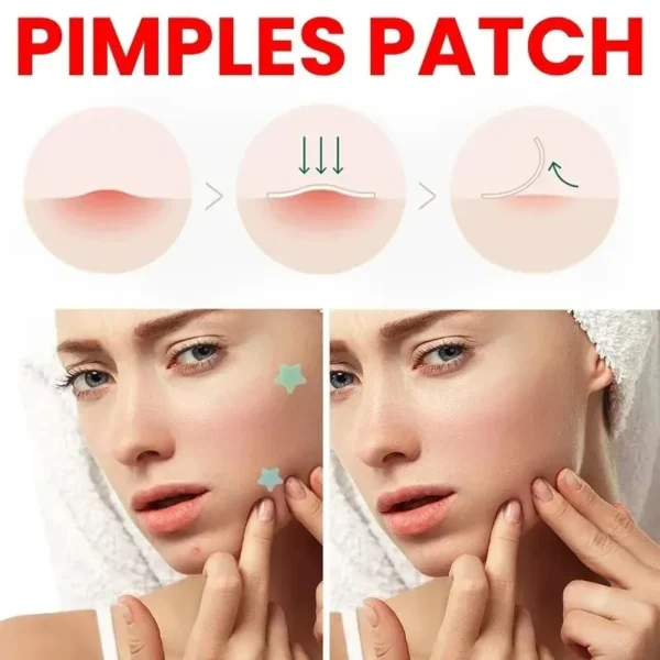 200pcs Repair Acne Patch Facial Skin Care Fade Blemishes Pimple Marks Closed Acne Blemishes Cover Acne Pimple Repair Patch - Image 4